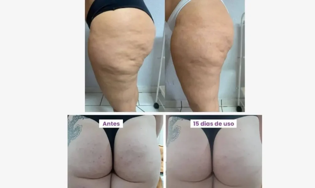 creme-anticelulite-antes-depois-termoativo